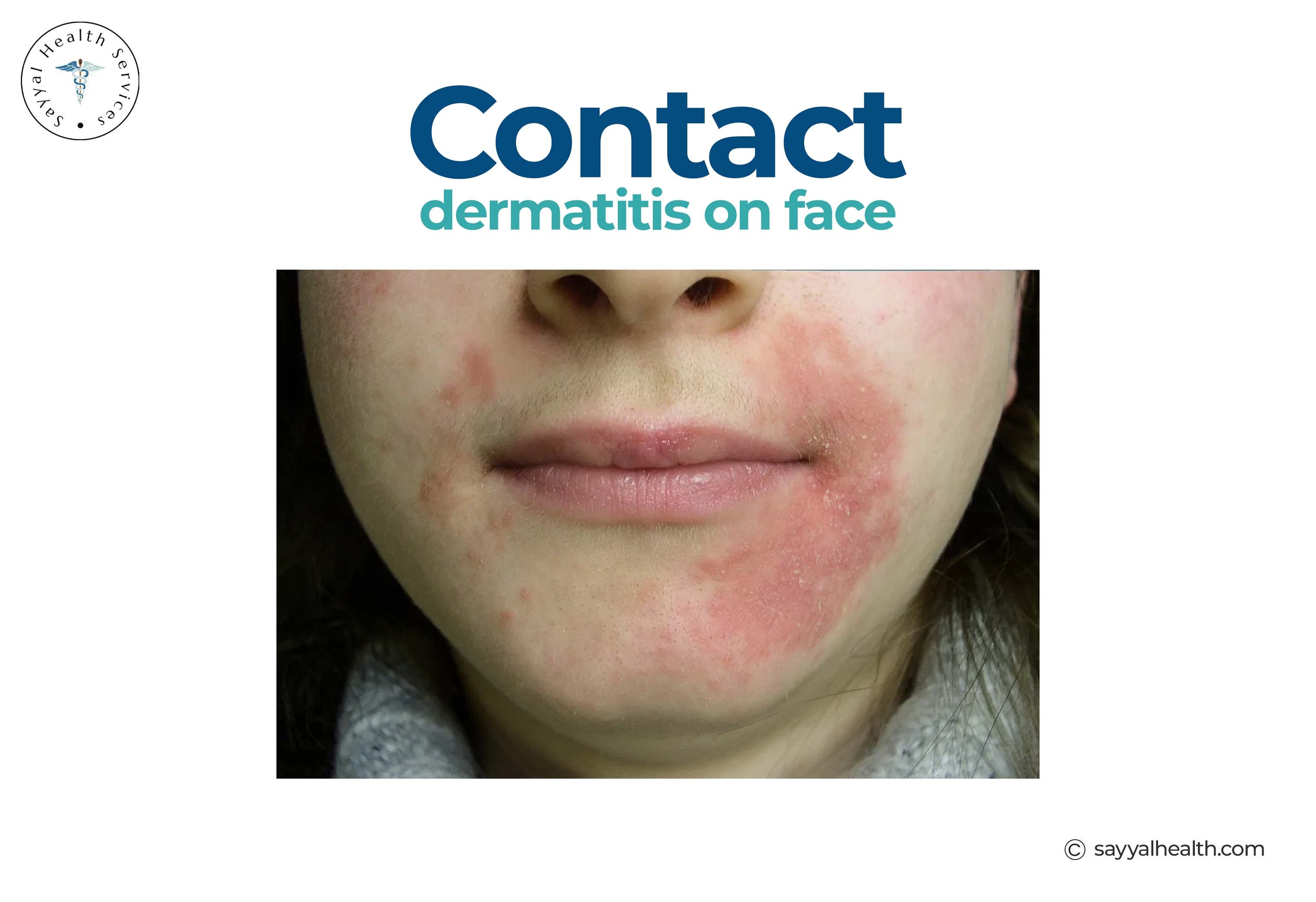 contact dermatitis on face